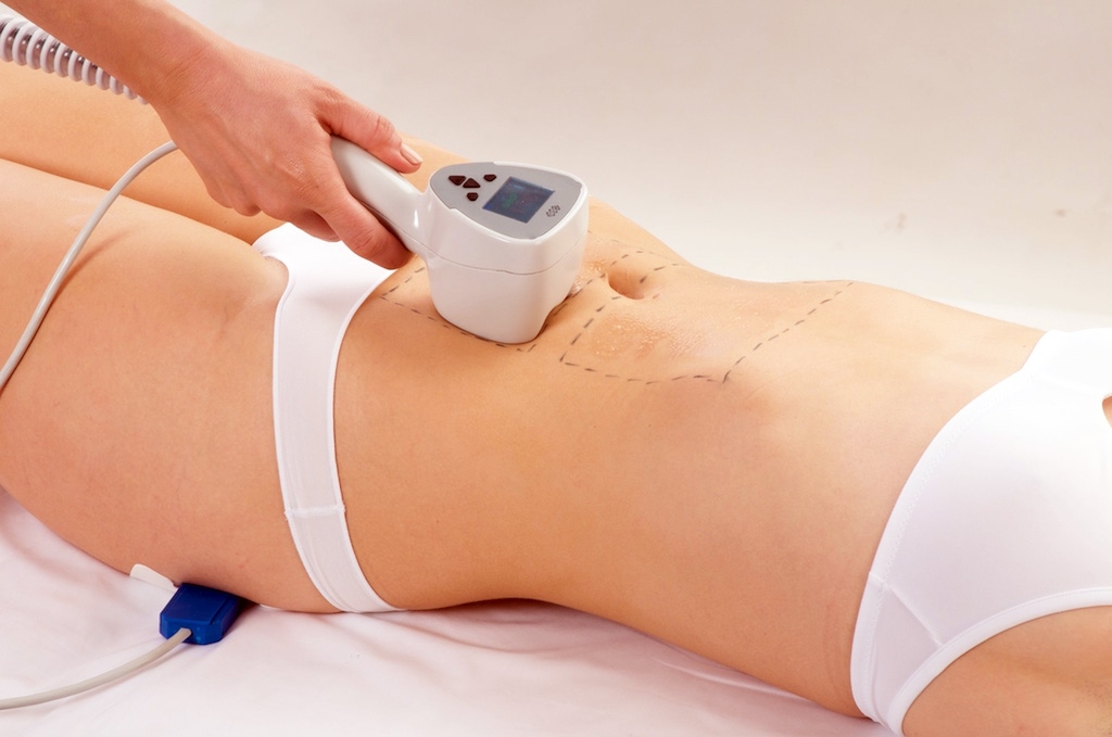 Radiofrequenza BTL Exilis System